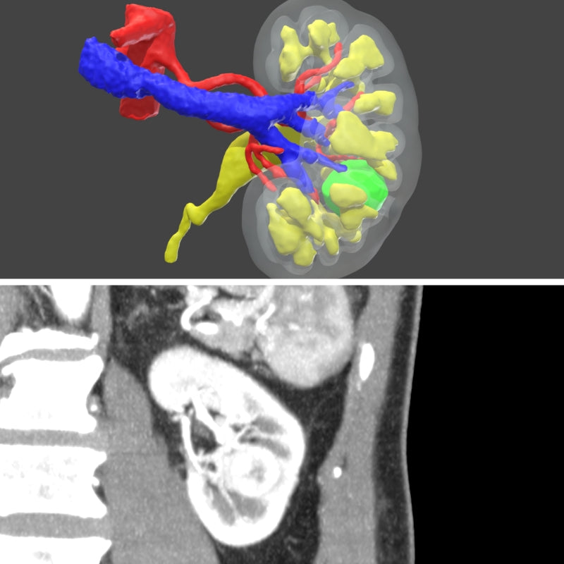 Surgical planning - Digital 3D model for urology