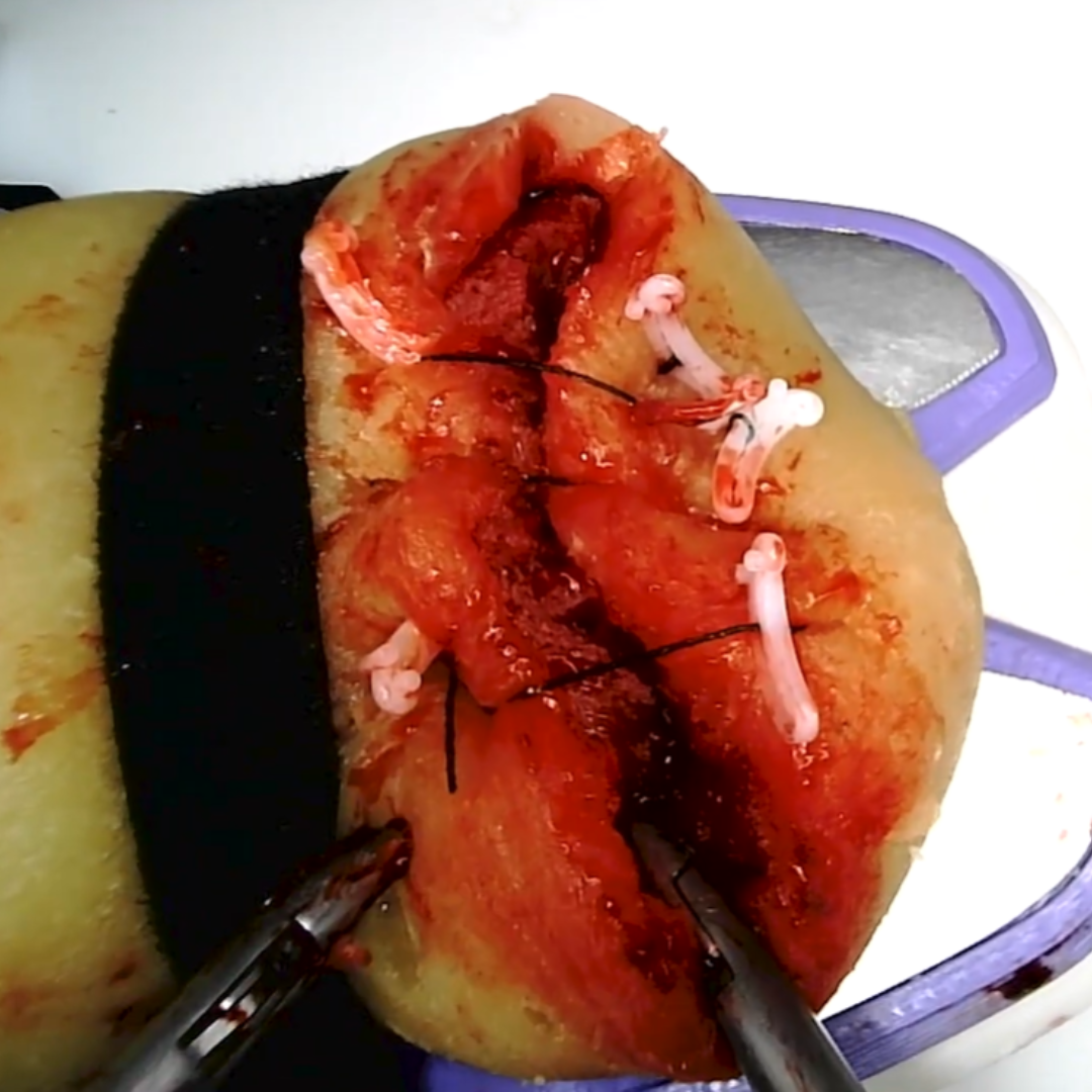 Perfused Model - Partial Nephrectomy Simulator