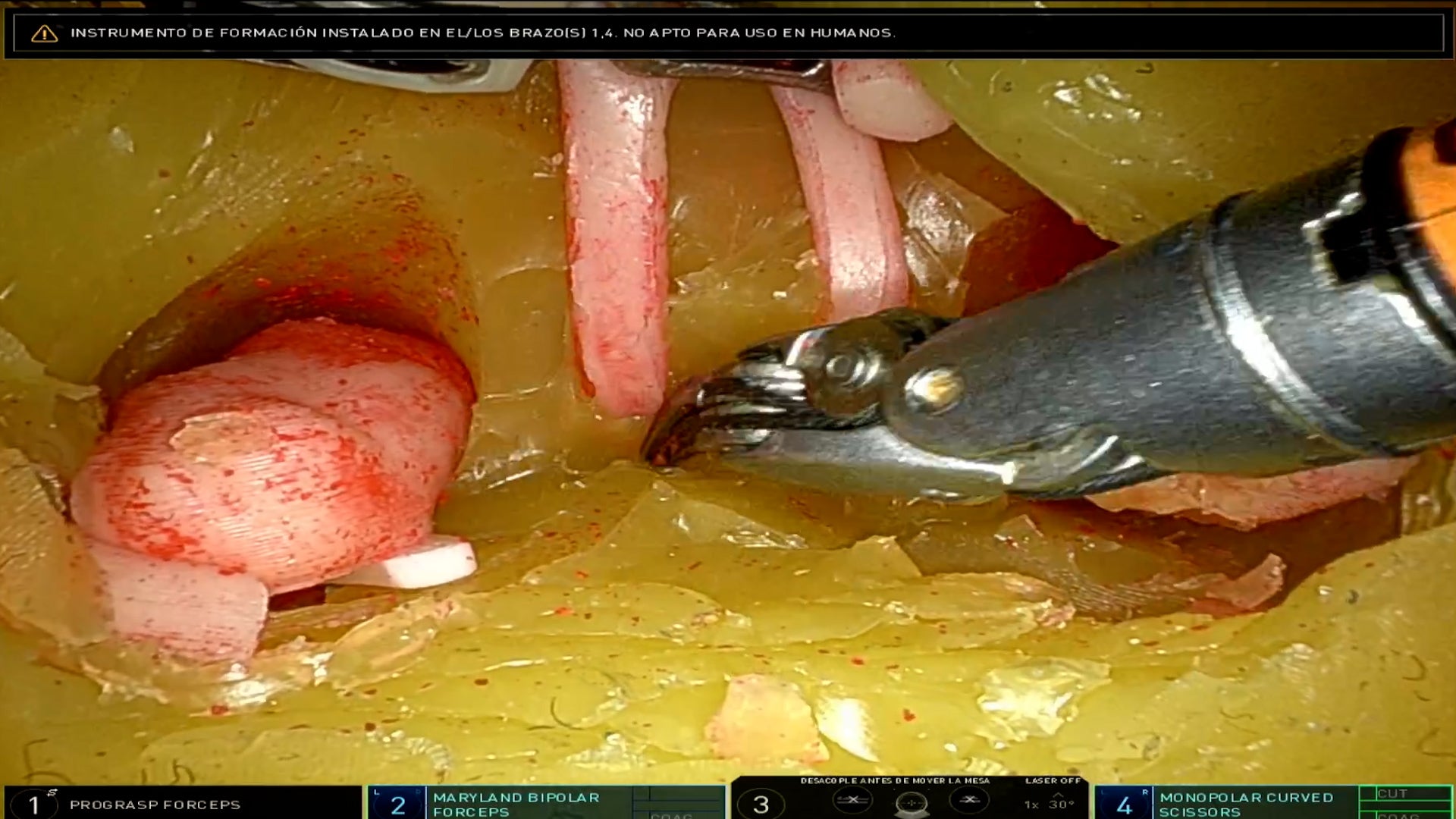 Retzius Sparing Radical Prostatectomy